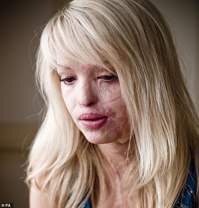 Katie Piper en 2009 après l'attaque à l'acide