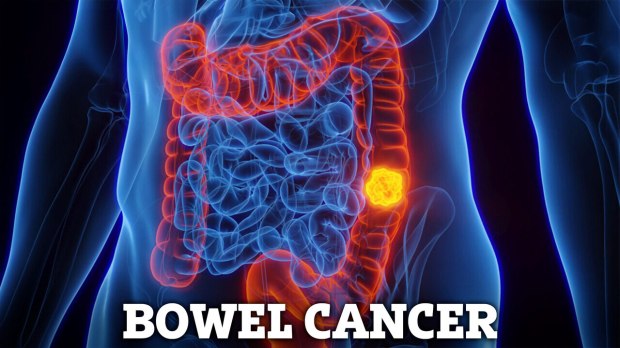 Illustration sur le cancer colorectal