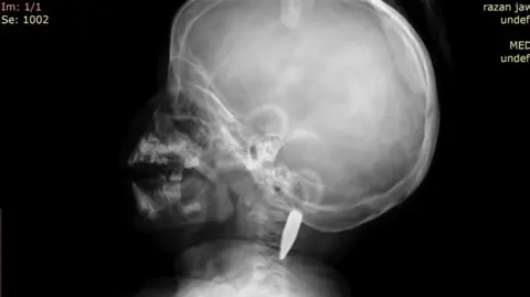 Scanner CT montrant la balle dans le cou de la fillette