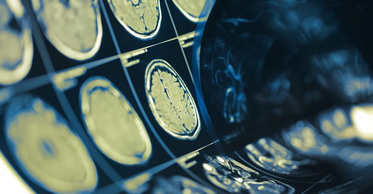 Images radiologiques cérébrales – journée de sensibilisation prévention AVC au CHU de Nantes