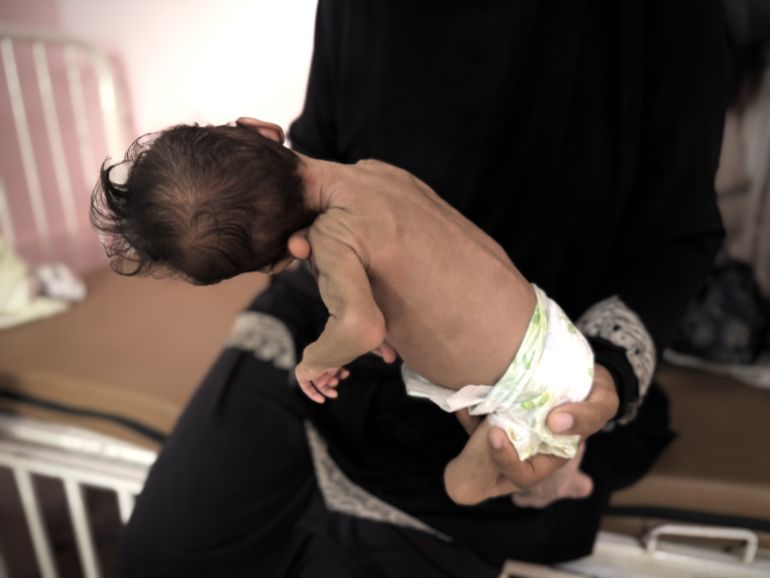 Enfant souffrant de malnutrition à Khan Younès, sud de Gaza
