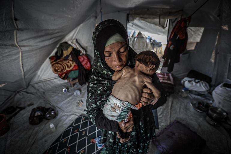 Enfant palestinien souffrant de malnutrition sévère à Gaza