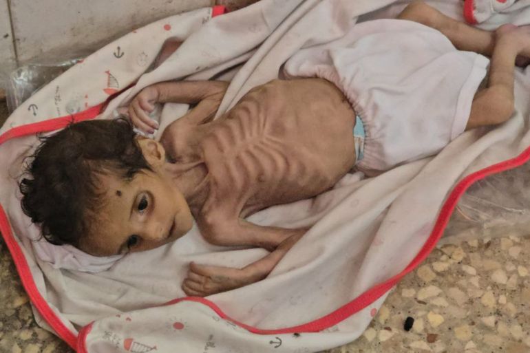 Décès d'un nourrisson à Deir al-Balah lié à la malnutrition et au manque de lait infantile