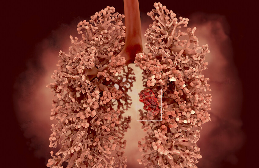 Nouveau médicament offrant de l’espoir pour un cancer très agressif