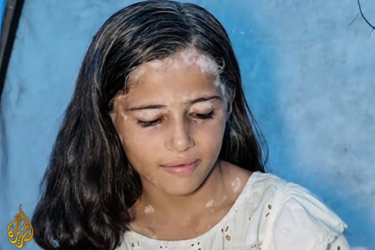 Lana al-Sharif, 8 ans, atteinte de vitiligo après une frappe